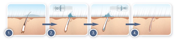 Beispiel dauerhafte Haarwuchsreduktion mit EpilaDerm Enzympflege